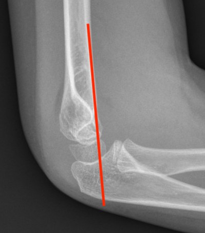 Anterior Humeral Line