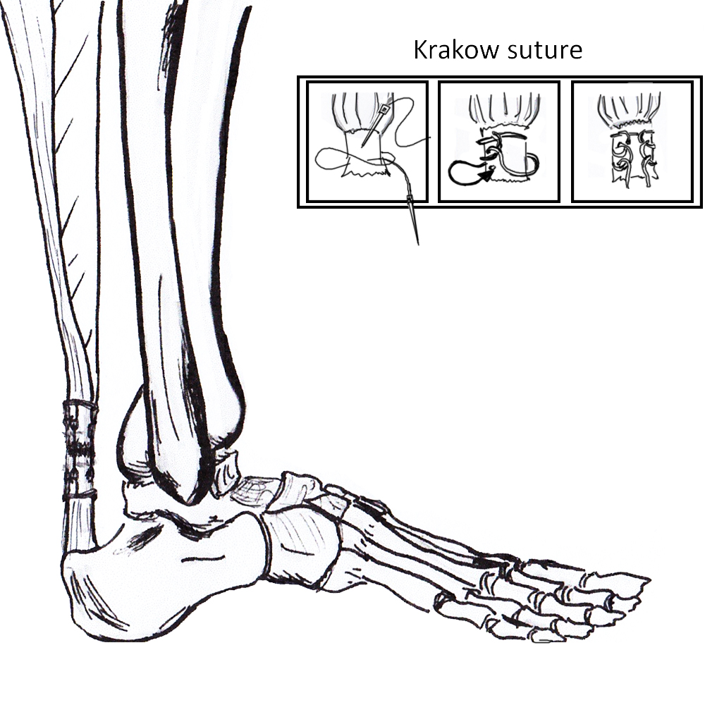 Achilles tendon repair