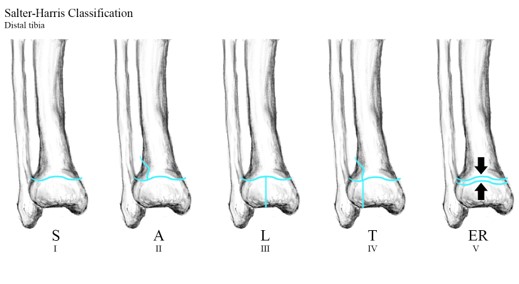 Salter Harris Classification