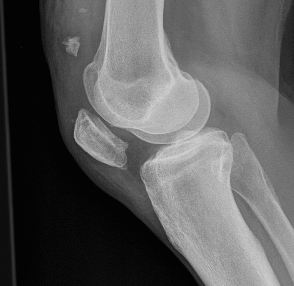 Patella Baja