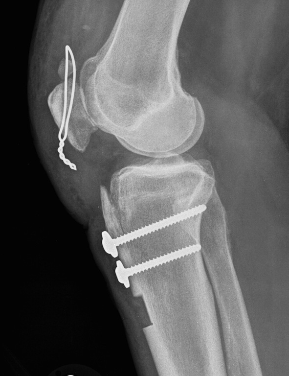 Post proximalization tibial tuberosity