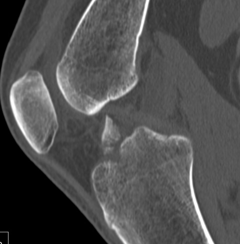 Type 3 ACL Avulsion