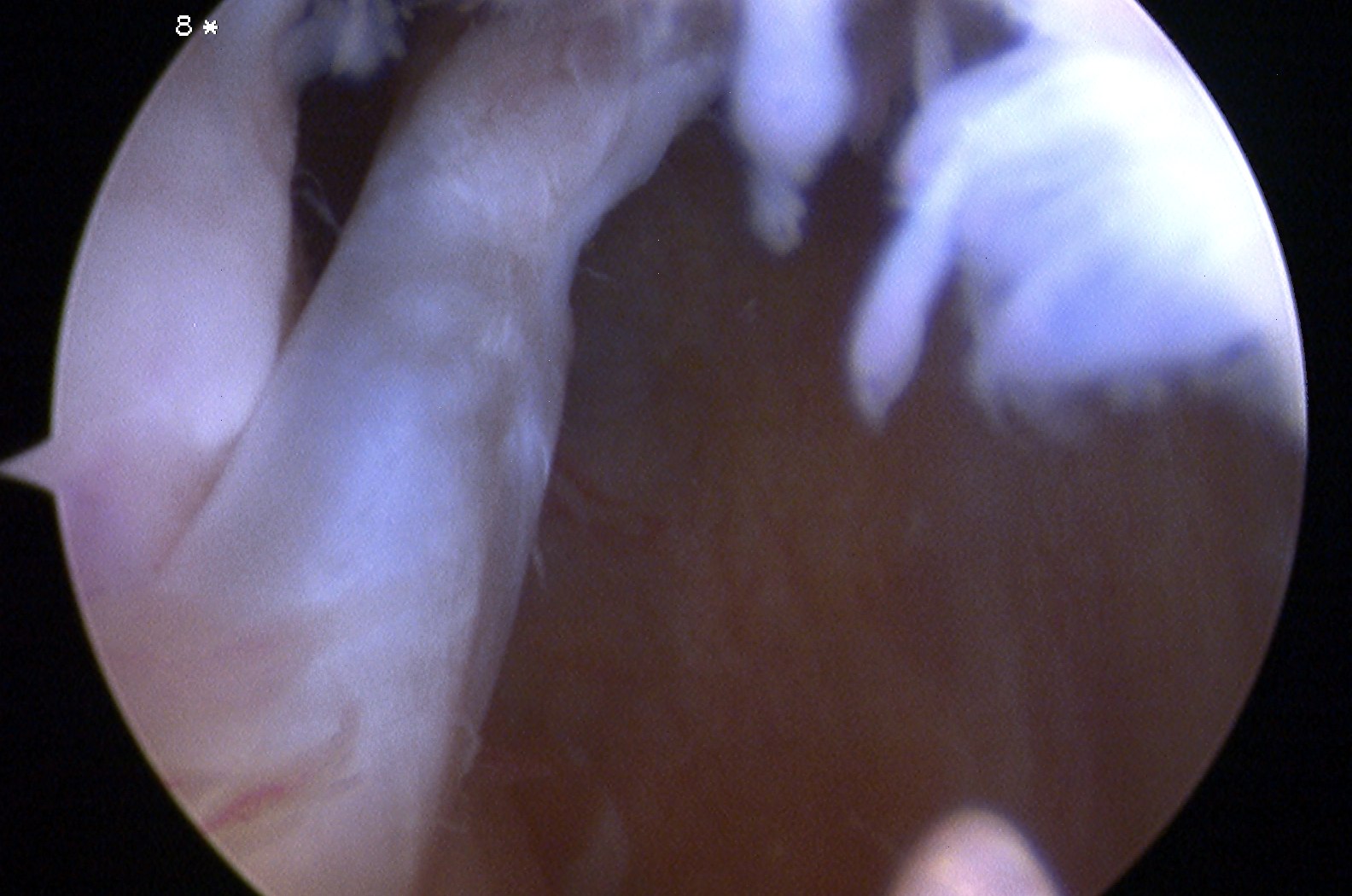 Knee Arthroscopy Intra-articular adhesions