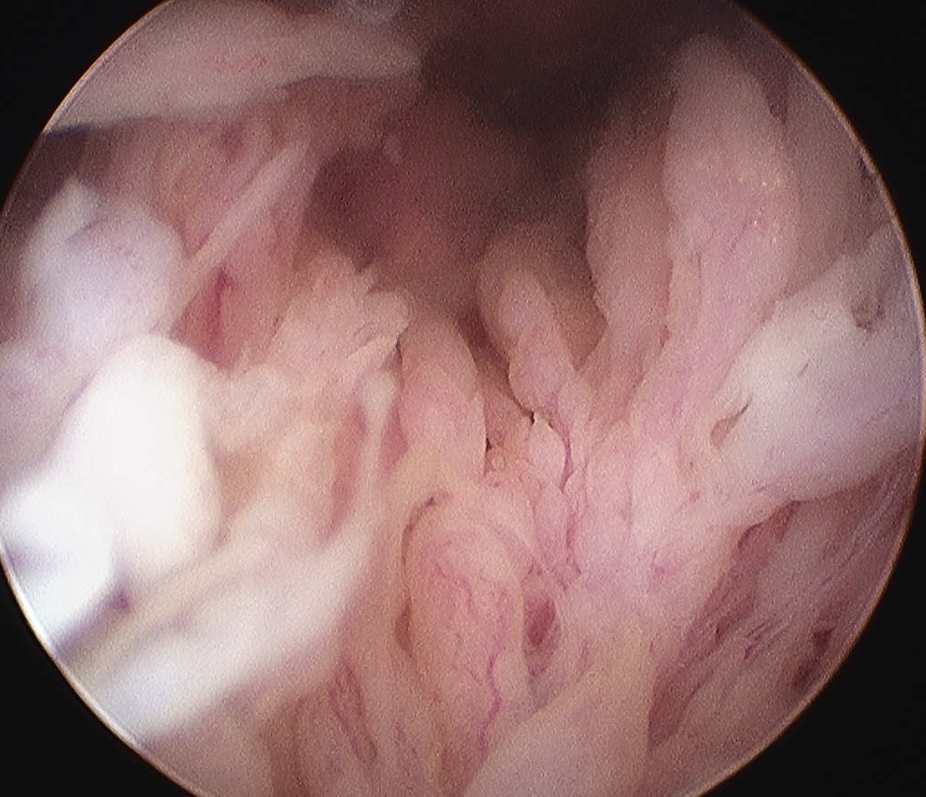 Lipoma Arborescens Knee Arthroscopy