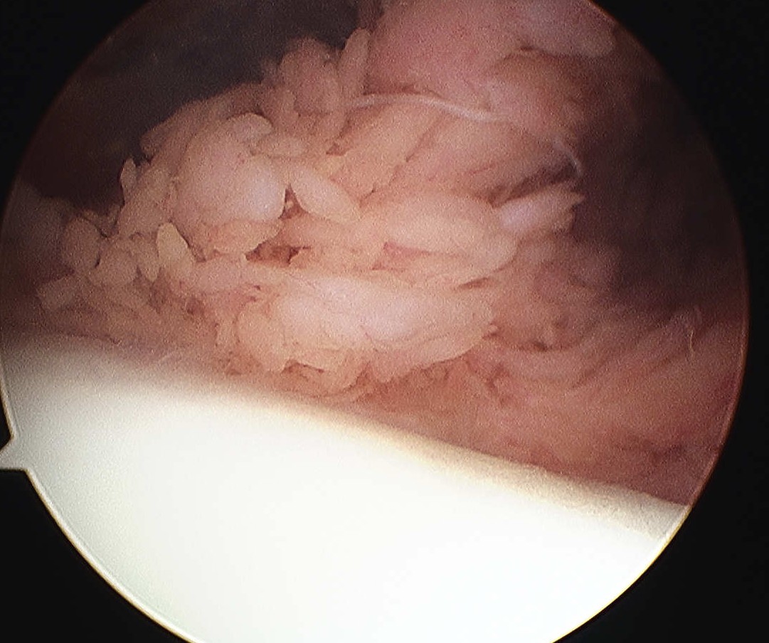 Lipoma Arborescens Knee Arthroscopy 1