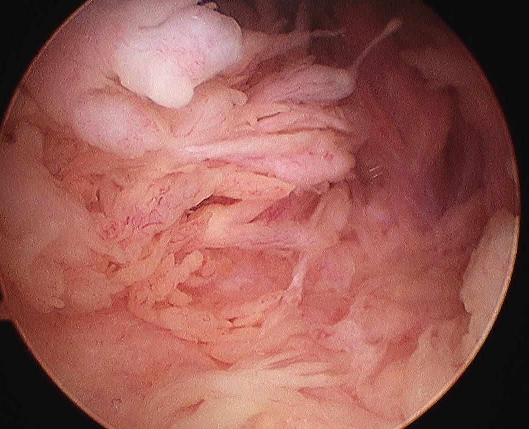 Lipoma Arborescens Knee Arthroscopy 2