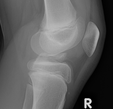 ACL Avulsion Type 2