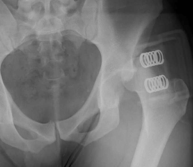 Posterior Hip Dislocation