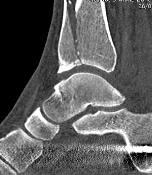 Tibial Plafond CT Sagittal