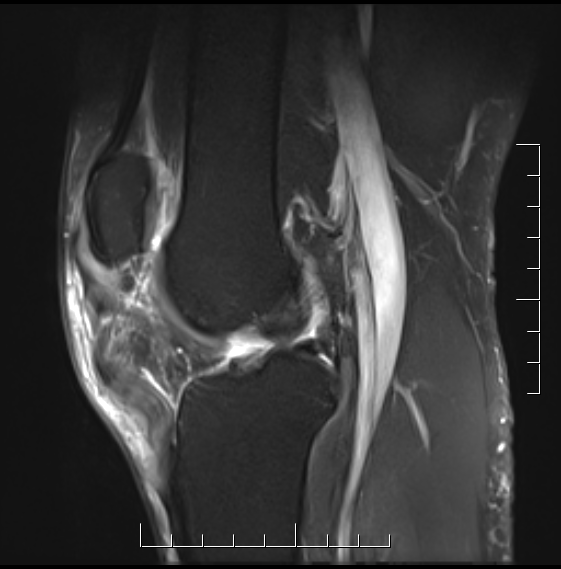 Patella Tendon Rupture MRI