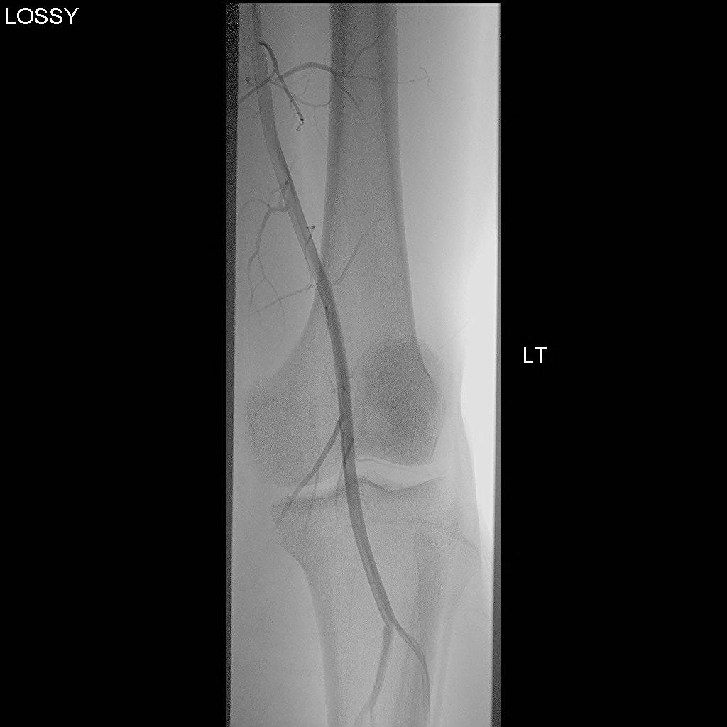 Angiogram Normal 1