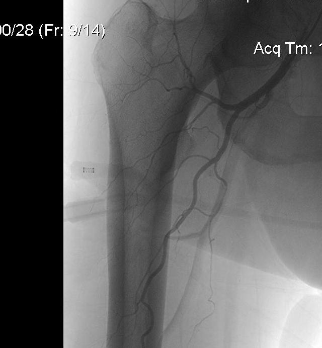 Angiogram Proximal Femur0001