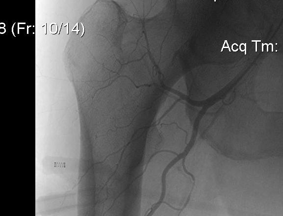 Angiogram Proximal Femur0002