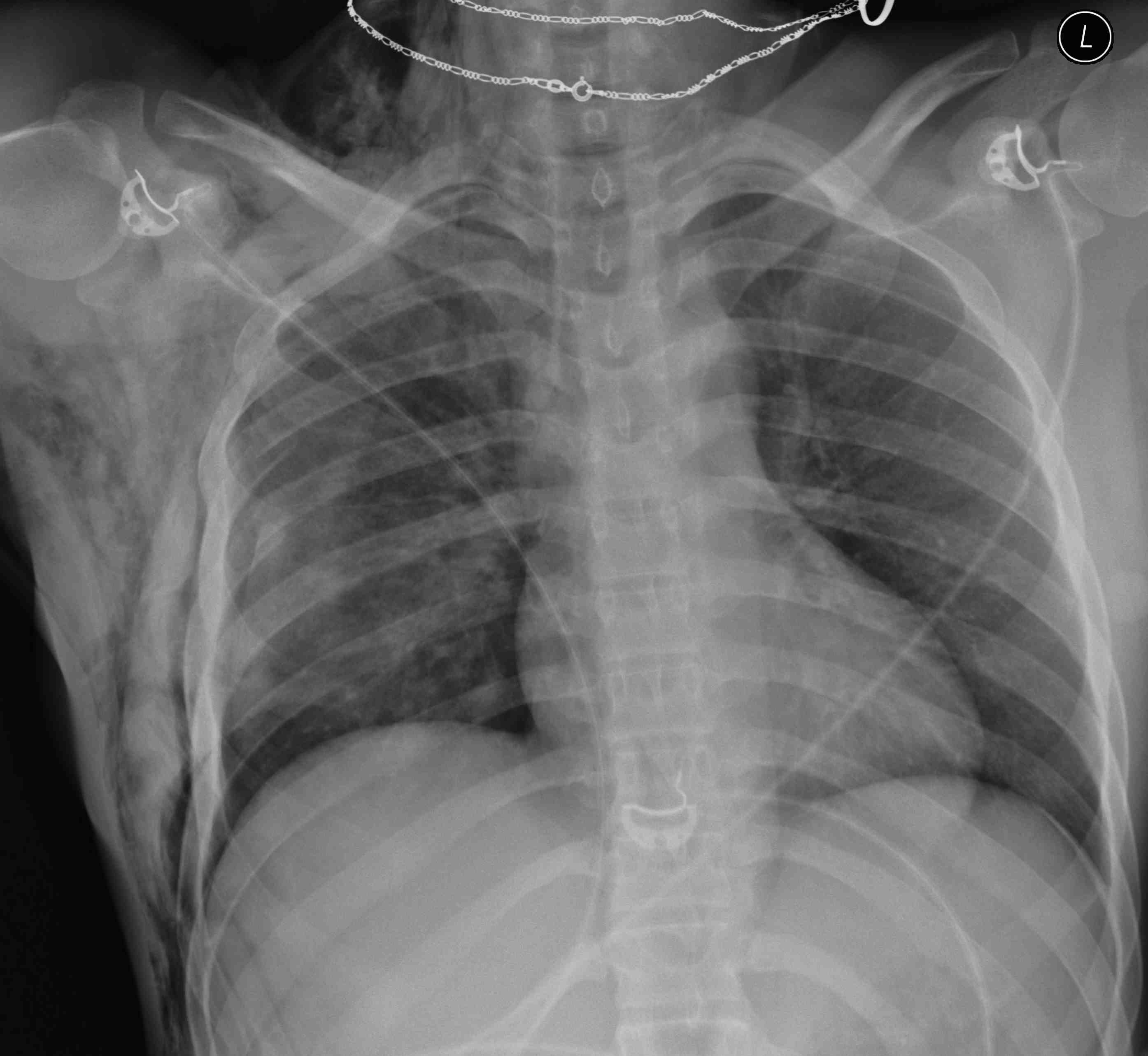 Pneumothorax