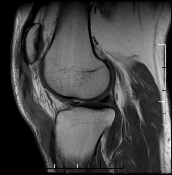 Patella Tendon Rupture MRI