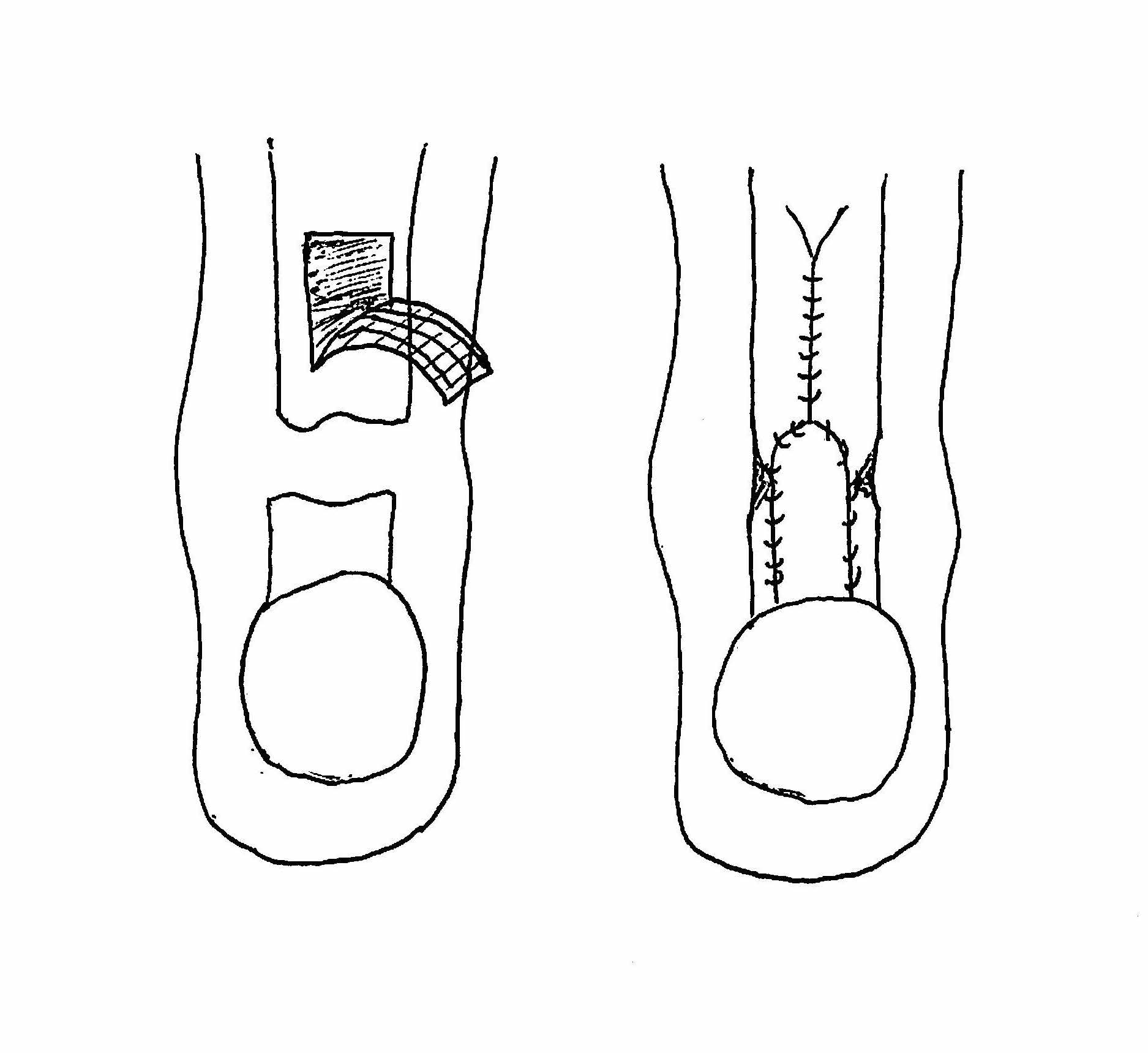 Achilles Tendon Turndown