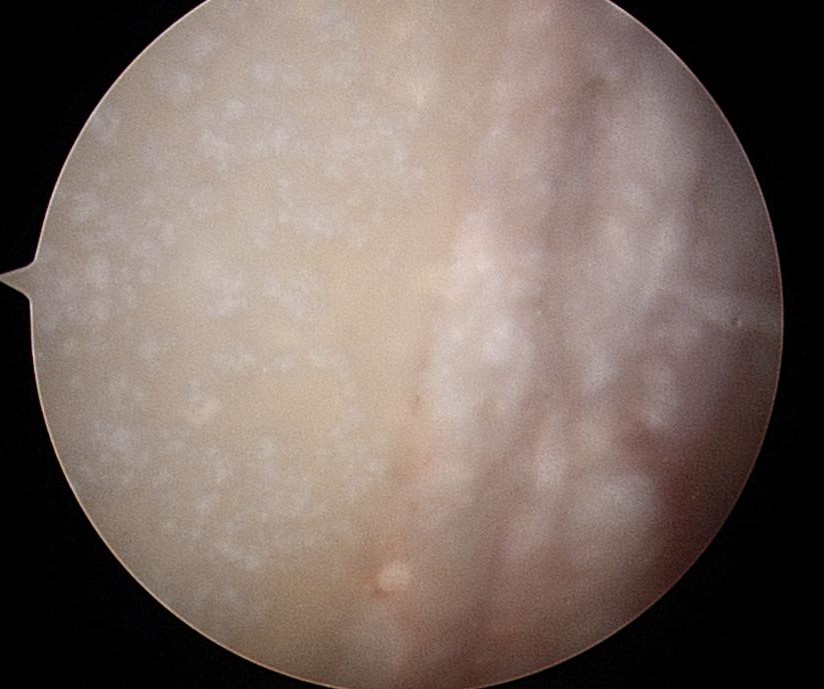 Chondrocalcinosis Glenoid Arthroscopy