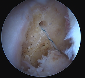 Acute PCL femoral Peel off