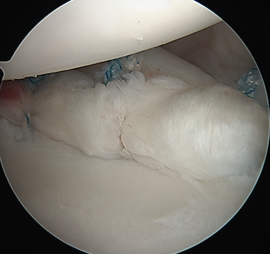 Capsular laxity post plication with suture anchor