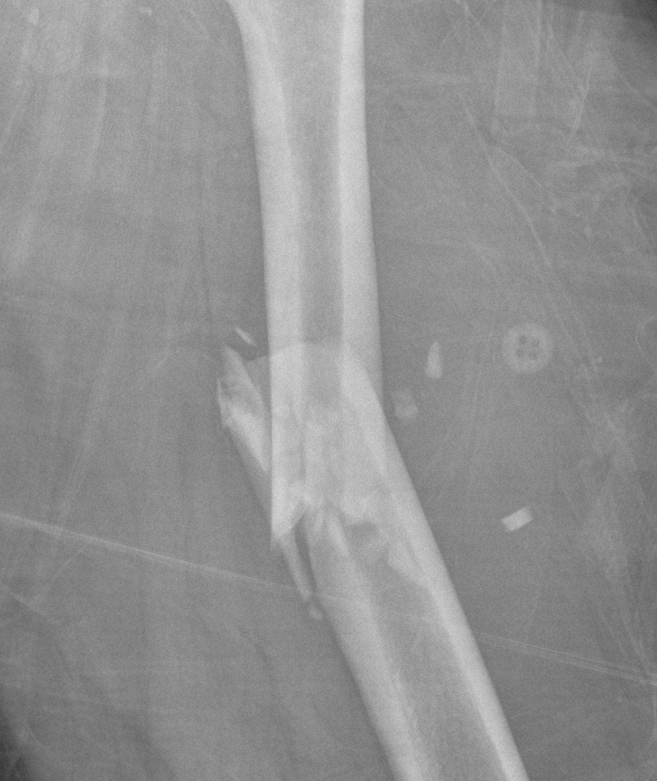 Femur fracture