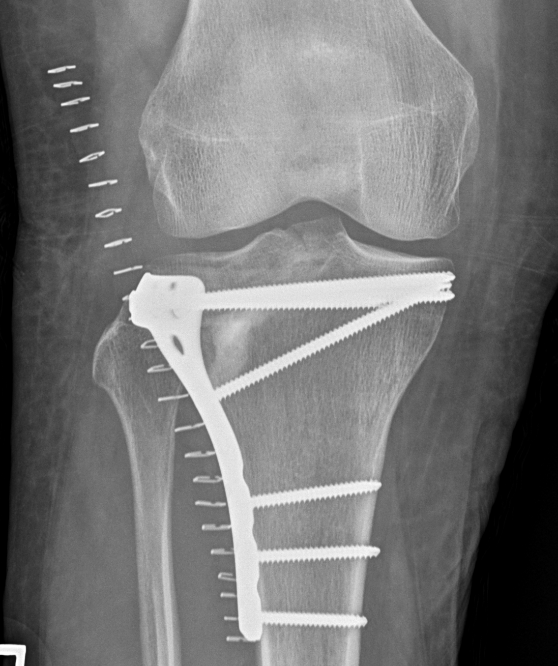 Type III tibial plateau ORIF