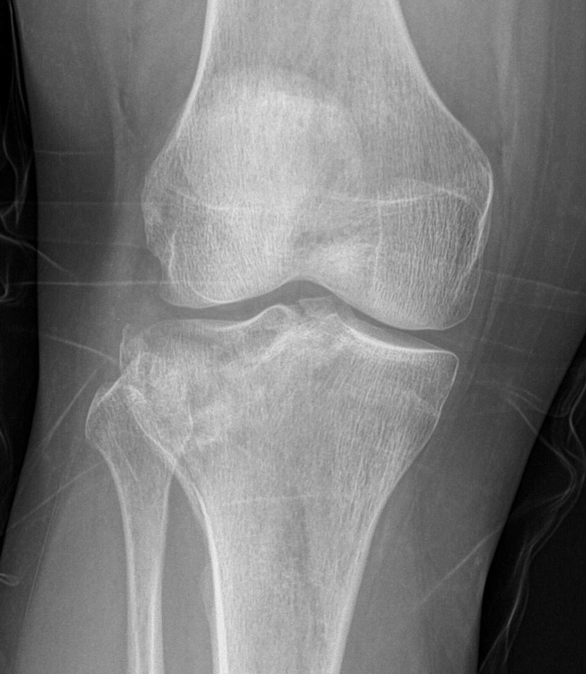 Type III tibial plateau