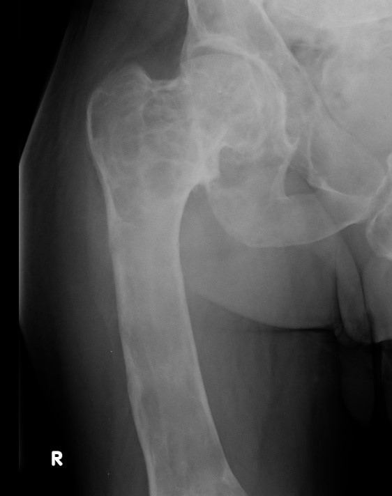 Fibrous dysplasia hip