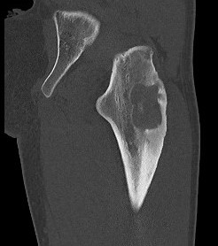 Osteoblastoma CT 3