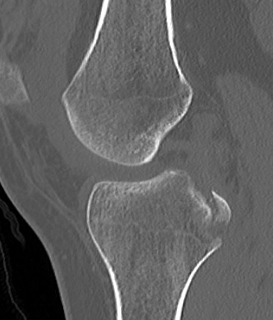 CT PCL bony avulsion