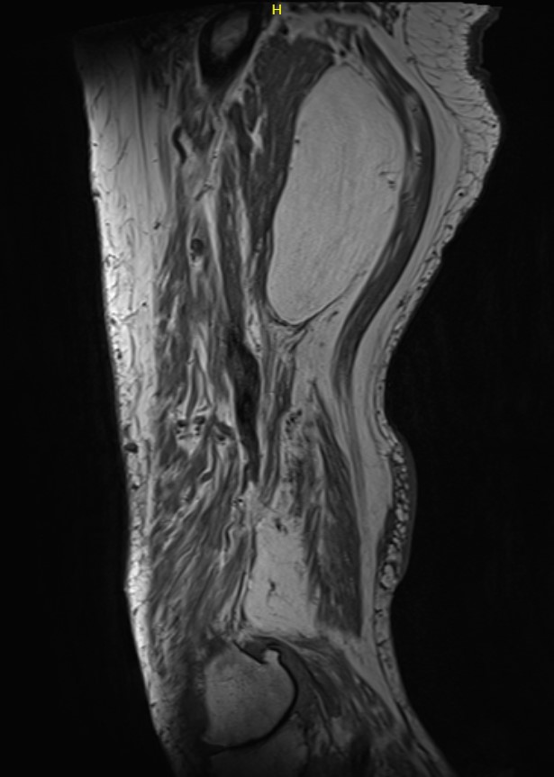 Liposarcoma 3