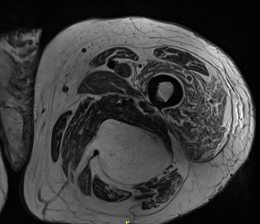 Liposarcoma 2