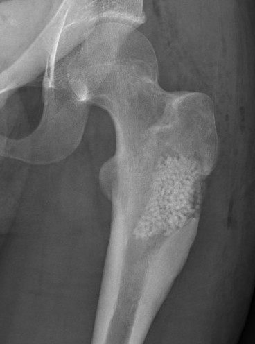 OB bone graft