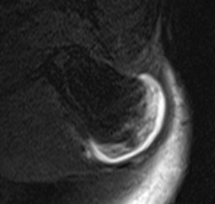 Osteochondroma MRI