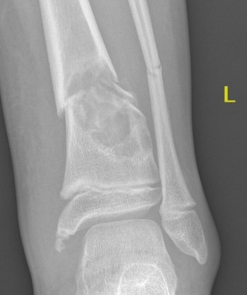 UBC distal tibia