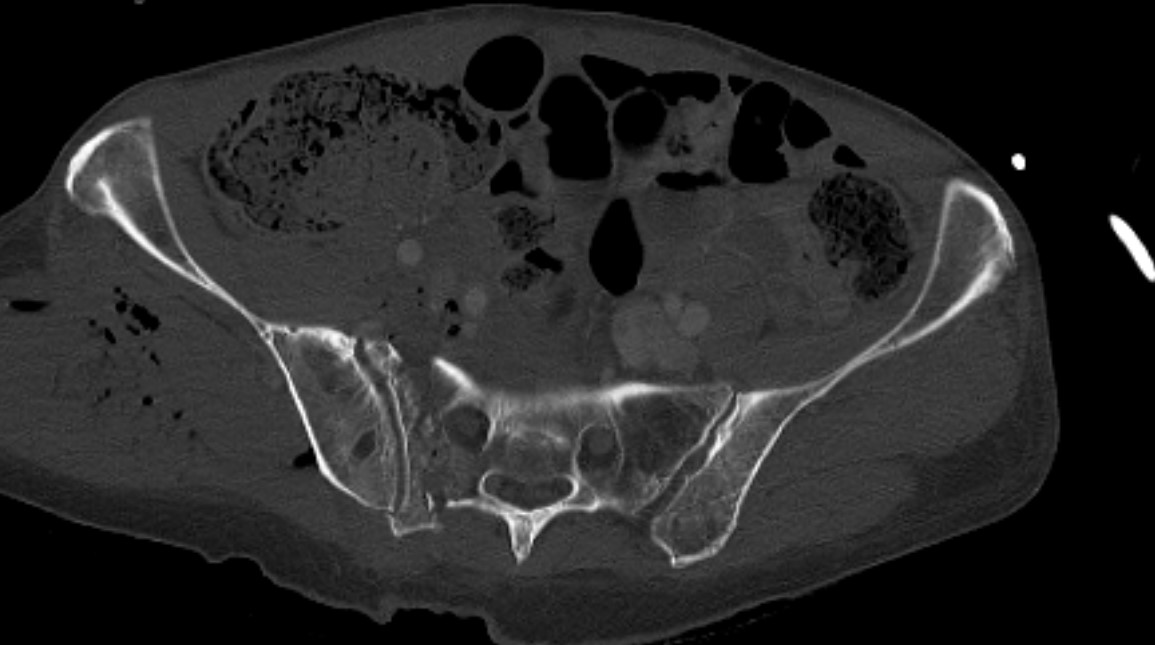 Sacral fracture