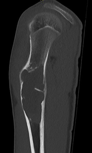 CT humerus UBC