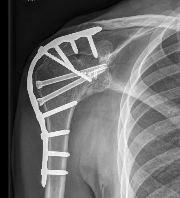 Shoulder arthrodesis