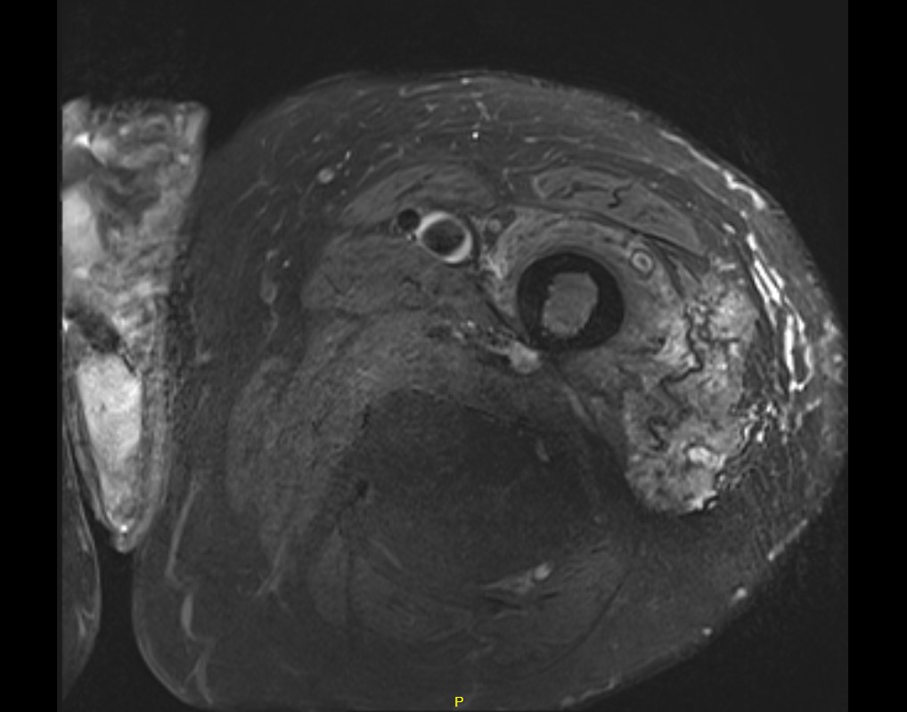 Liposarcoma 1