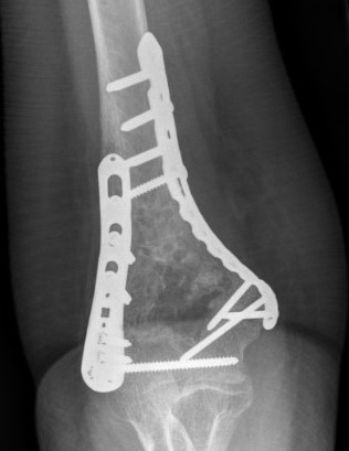 Elbow orthogonal plates 1