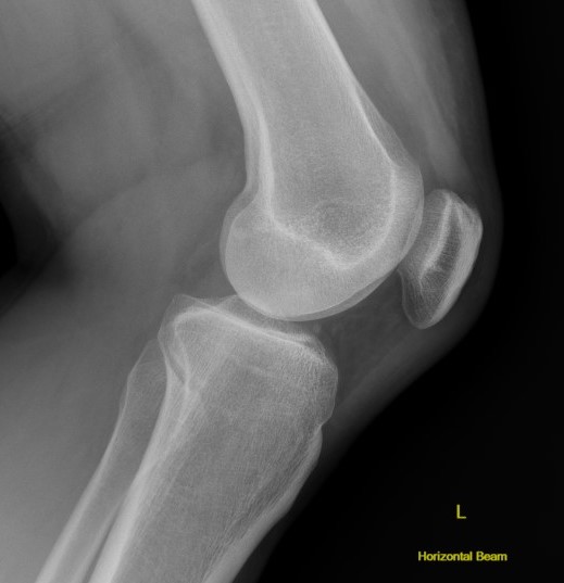 Posterior tibial subluxation xray