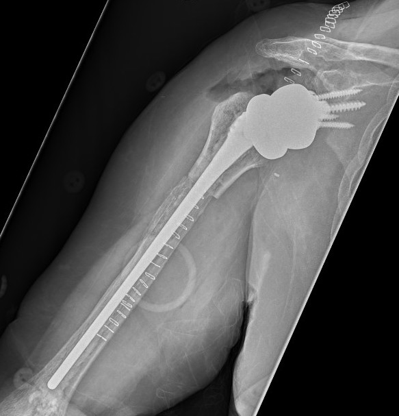 Revision TSA proximal humerus allograft