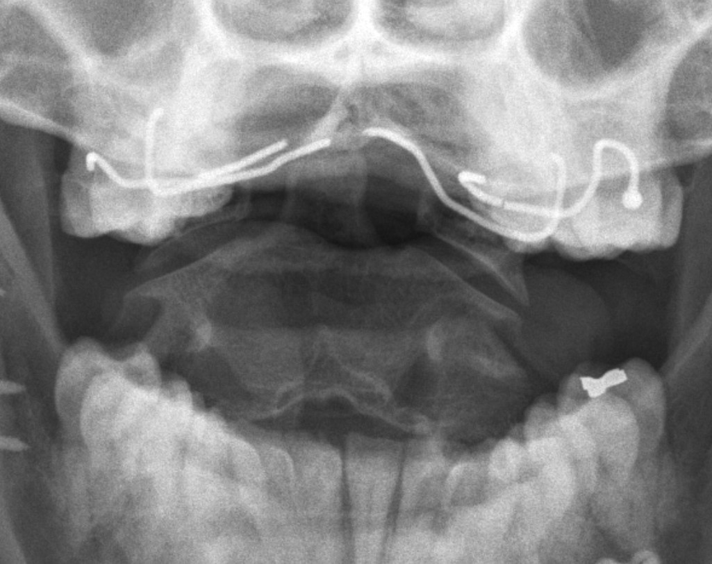 Atlanto-axial open mouth