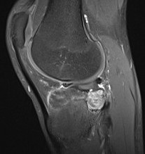 Chondroblastoma MRI