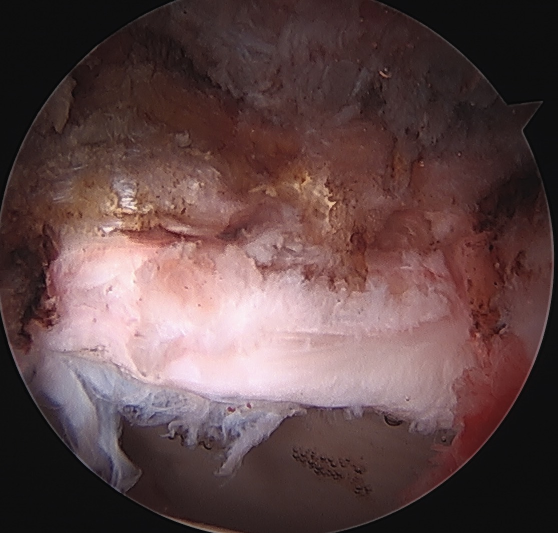 Labral repair