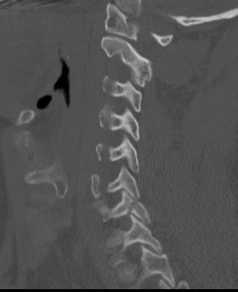 Large superior articular facet fracture