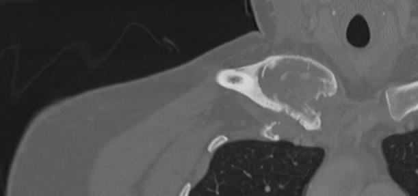 ABC clavicle CT