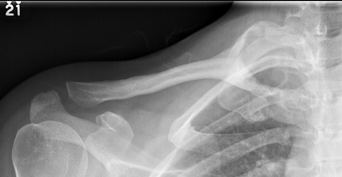 ABC clavicle