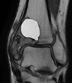 ABC ankle MRI 2