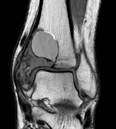 ABC ankle mri 1