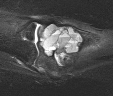 ABC MRI fluid fluid levels